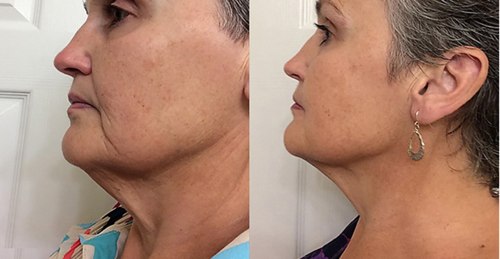 DermaGlow™ Facial & Neck Lifting Device, Skin Rejuvenation Device