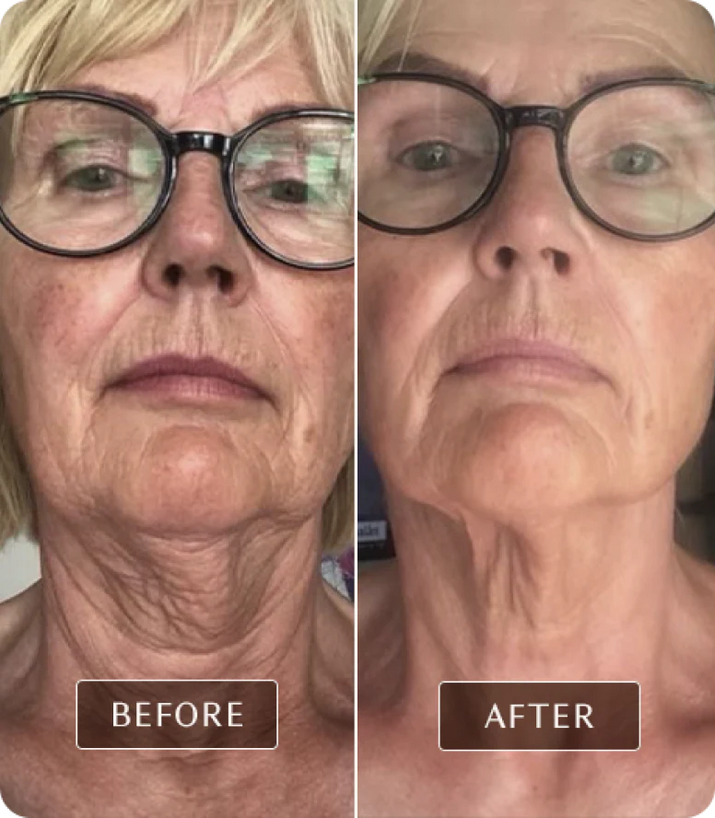 DermaGlow™ Facial & Neck Lifting Device, Skin Rejuvenation Device