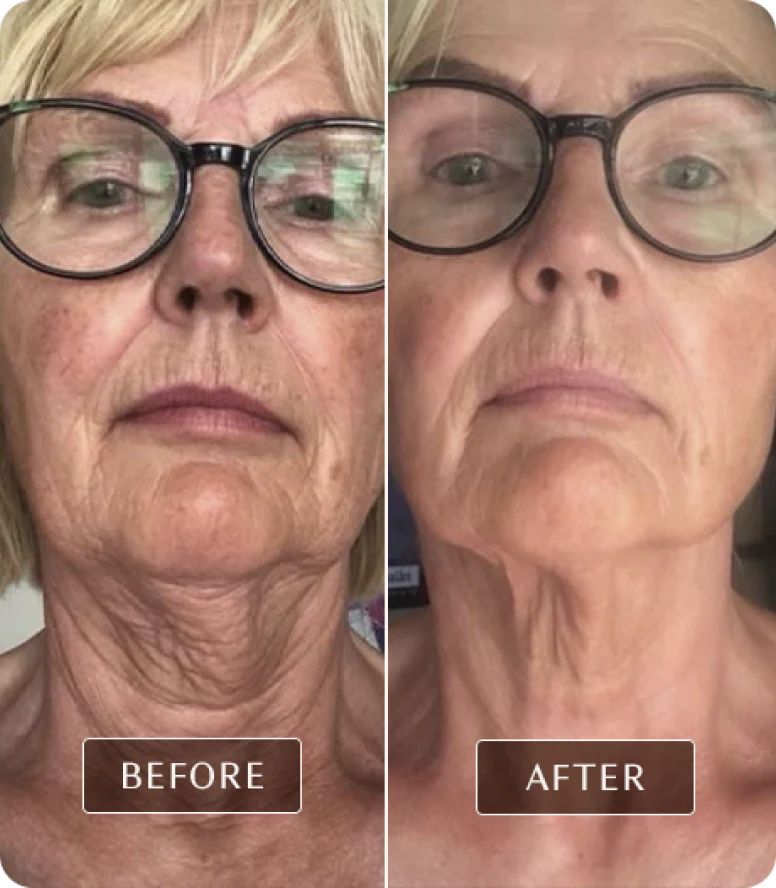 DermaGlow™ Facial & Neck Lifting Device, Skin Rejuvenation Device