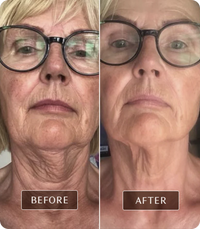 DermaGlow™ Facial & Neck Lifting Device, Skin Rejuvenation Device