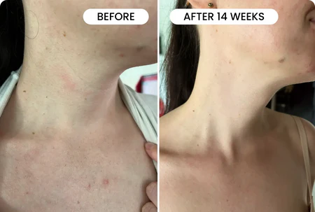 DermaGlow™ Facial & Neck Lifting Device, Skin Rejuvenation Device