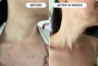 DermaGlow™ Facial & Neck Lifting Device, Skin Rejuvenation Device
